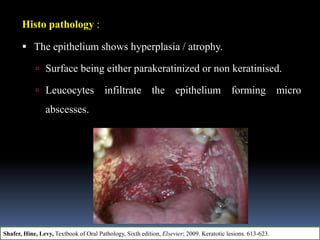 Histo pathology :
 The epithelium shows hyperplasia / atrophy.
 Surface being either parakeratinized or non keratinised.
 Leucocytes infiltrate the epithelium forming micro
abscesses.
Shafer, Hine, Levy, Textbook of Oral Pathology, Sixth edition, Elsevier; 2009. Keratotic lesions. 613-623.
 