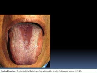 Shafer, Hine, Levy, Textbook of Oral Pathology, Sixth edition, Elsevier; 2009. Keratotic lesions. 613-623.
 