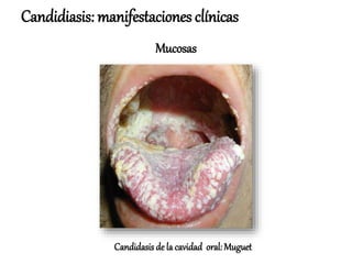 Candidiasis: manifestaciones clínicas
Mucosas
Candidasis de la cavidad oral: Muguet
 