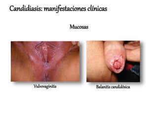 Candidiasis: manifestaciones clínicas
Mucosas
Vulvovaginitis Balanitis candidósica
 