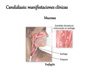 Candidiasis: manifestaciones clínicas
Esofagitis
Mucosas
 