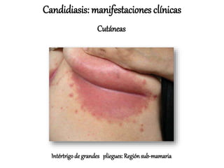 Intértrigo de grandes pliegues: Región sub-mamaria
Candidiasis: manifestaciones clínicas
Cutáneas
 