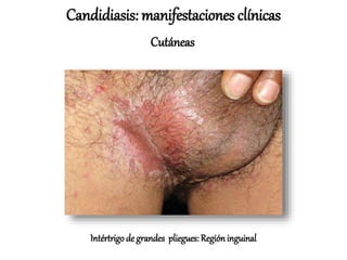 Intértrigo de grandes pliegues: Regióninguinal
Candidiasis: manifestaciones clínicas
Cutáneas
 