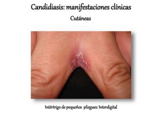 Intértrigo de pequeños pliegues: Interdigital
Candidiasis: manifestaciones clínicas
Cutáneas
 