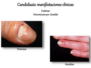 Onicomicosispor Candida
Candidiasis: manifestaciones clínicas
Cutáneas
Perionixis
Onicólisis
 