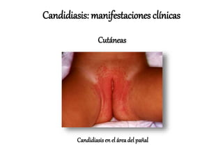 Candidiasisen el áreadel pañal
Candidiasis: manifestaciones clínicas
Cutáneas
 