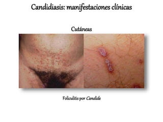 Foliculitis por Candida
Candidiasis: manifestaciones clínicas
Cutáneas
 
