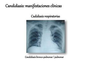 Candidiasis: manifestaciones clínicas
Candidiasis bronco-pulmonar/ pulmonar
Cadidiasis respiratorias
 