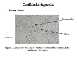 Candidiasis: diagnóstico
1. Examendirecto:
 
