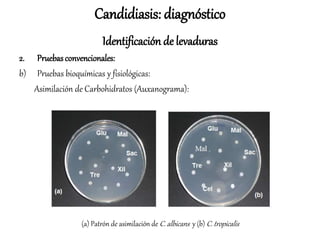 Candidiasis: diagnóstico
Identificación de levaduras
2. Pruebasconvencionales:
b) Pruebas bioquímicas y fisiológicas:
Asimilación de Carbohidratos (Auxanograma):
(a) Patrón de asimilación de C. albicans y (b) C. tropicalis
 