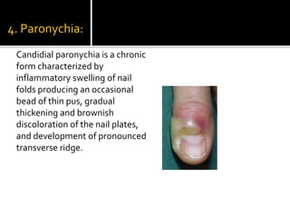 4. Paronychia:
Candidial paronychia is a chronic
form characterized by
inflammatory swelling of nail
folds producing an occasional
bead of thin pus, gradual
thickening and brownish
discoloration of the nail plates,
and development of pronounced
transverse ridge.
 