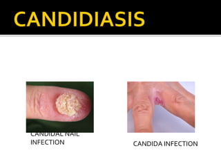 CANDIDAL NAIL
INFECTION CANDIDA INFECTION
 