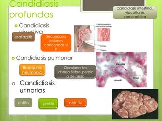 Candidiasis                                          candidiasis intestinal,

profundas                                               vías biliares,
                                                        pancreática

  Candidiasis
   digestiva
 esofagitis         Secundaria
                      lesiones
                   cancerosas,vi
                          h

 Candidiasis        pulmonar
     Bronquitis                  Ocasiona tos
     neumonía                ,disnea,fiebre,perdid
                                   a de peso

o Candidiasis
  urinarias
  cistitis        pielitis         nefritis
 