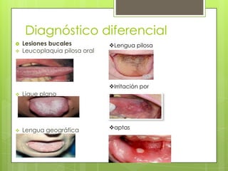 Diagnóstico diferencial
   Lesiones bucales           Lengua pilosa
   Leucoplaquia pilosa oral




                               Irritación por
   Lique plano                mordida




   Lengua geográfica          aptas
 