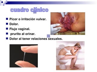  Picor o irritación vulvar.
Dolor.
Flujo vaginal.
prurito al orinar.
Dolor al tener relaciones sexuales.