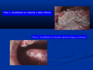 Foto 1. Candidiasis en reborde y labio inferior.
Foto 2.  Candidiasis en reborde superior, lengua y comisura
 