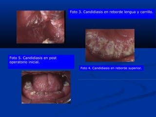 Foto 3. Candidiasis en reborde lengua y carrillo.
Foto 4. Candidiasis en reborde superior.
Foto 5. Candidiasis en post
operatorio inicial.
 