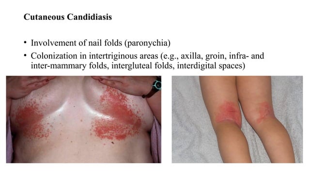 Candidiasis An overview Dr Rajesh Patil Sir.pptx