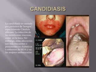 La candidiasis es causada
por parásitos de 'hongos',
especialmente Cándida
albicans. La infección de
las membranas mucosas,
como en la boca. Sin
embargo, estas afecciones
son más frecuentes o
persistentes en diabéticos
o enfermos de SIDA y en
las mujeres embarazadas.
 