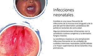 Infecciones
neonatales
Candida es una causa frecuente de
infecciones de la mucosa oral (muguet) y de la
piel del periné (dermatitis candidiásica del
pañal) en lactantes de corta edad.
Algunas presentaciones infrecuentes son la
candidiasis cutánea congénita y la dermatitis
fúngica invasiva.
La candidiasis invasiva es una complicación
infecciosa frecuente en las unidades de
cuidados intensivos neonatales (UCIN) debido
a la mayor supervivencia de los lactantes muy
prematuros.
 