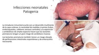 Infecciones neonatales
Patogenia
La inmadurez inmunitaria junto con un desarrollo insuficiente
de la capa cutánea, la necesidad de medidas cruentas (tubos
endotraqueales, catéteres venosos centrales) y la exposición
a antibióticos de amplio espectro hacen que los lactantes
prematuros tengan un gran riesgo de candidiasis invasiva.
Los lactantes prematuros también tienen un riesgo elevado
de perforaciones intestinales espontáneas y de enterocolitis
necrosante.
 