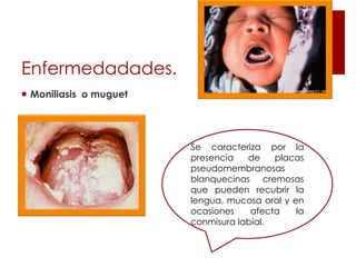  Moniliasis o muguet
Enfermedadades.
Se caracteriza por la
presencia de placas
pseudomembranosas
blanquecinas cremosas
que pueden recubrir la
lengua, mucosa oral y en
ocasiones afecta la
conmisura labial.
 