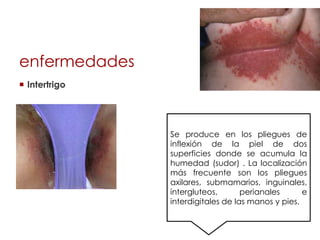 enfermedades
 Intertrigo
Se produce en los pliegues de
inflexión de la piel de dos
superficies donde se acumula la
humedad (sudor) . La localización
más frecuente son los pliegues
axilares, submamarios, inguinales,
intergluteos, perianales e
interdigitales de las manos y pies.
 