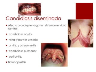 Candidiasis diseminada
 Afecta a cualquier organo : sistema nervioso
central
 candidiasis ocular
 renal y las vias urinaria
 artritis, y osteomyelitis
 candidiasis pulmonar
 peritonitis.
 Balanopostitis
 