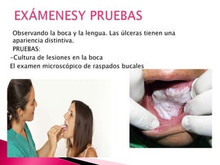 Observando la boca y la lengua. Las úlceras tienen una
apariencia distintiva.
PRUEBAS:
-Cultura de lesiones en la boca
El examen microscópico de raspados bucales
 