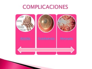 Artritis Endoftalmitis Meningitis
 
