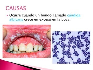  Ocurre cuando un hongo llamado cándida
albicans crece en exceso en la boca.
 