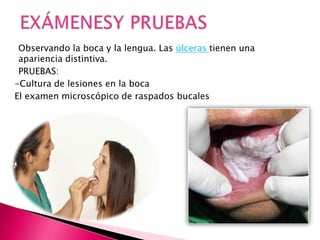 Observando la boca y la lengua. Las úlceras tienen una
apariencia distintiva.
PRUEBAS:
-Cultura de lesiones en la boca
El examen microscópico de raspados bucales
 