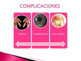 Artritis Endoftalmitis Men ingitis
 
