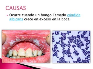  Ocurre cuando un hongo llamado cándida
albicans crece en exceso en la boca.
 