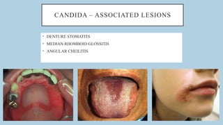 Oral Candidiasis: Clinical Features, Diagnosis and Management – By Dr ...