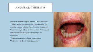 Oral Candidiasis: Clinical Features, Diagnosis and Management – By Dr ...
