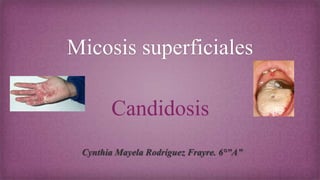 Micosis superficiales
Candidosis
Cynthia Mayela Rodríguez Frayre. 6°”A”
 