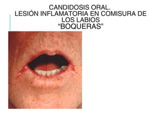 CANDIDOSIS ORAL.
LESIÓN INFLAMATORIA EN COMISURA DE
LOS LABIOS
“BOQUERAS”
 