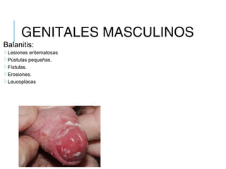 GENITALES MASCULINOS
Balanitis:
 Lesiones eritematosas
 Pústulas pequeñas.
 Fístulas.
 Erosiones.
 Leucoplacas
 