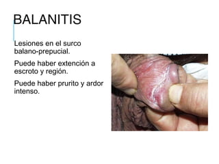 BALANITIS
Lesiones en el surco
balano-prepucial.
Puede haber extención a
escroto y región.
Puede haber prurito y ardor
intenso.
 