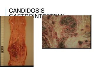 CANDIDOSIS
GASTROINTESTINAL
 