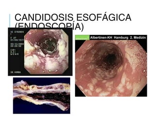 CANDIDOSIS ESOFÁGICA
(ENDOSCOPÍA)
 
