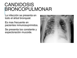 CANDIDOSIS
BRONCOPULMONAR
La infección se presenta en
todo el árbol bronquial.
Es mas frecuente en
pacientes inmunosuprimidos.
Se presenta tos constante y
expectoración mucoide.
 