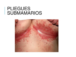 PLIEGUES
SUBMAMARIOS
 