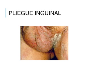 PLIEGUE INGUINAL
 