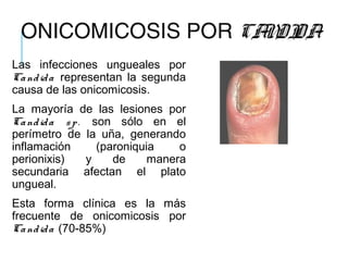 ONICOMICOSIS POR CANDIDA
Las infecciones ungueales por
Candida representan la segunda
causa de las onicomicosis.
La mayoría de las lesiones por
Candida sp. son sólo en el
perímetro de la uña, generando
inflamación (paroniquia o
perionixis) y de manera
secundaria afectan el plato
ungueal.
Esta forma clínica es la más
frecuente de onicomicosis por
Candida (70-85%)
 