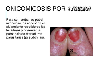 ONICOMICOSIS POR CANDIDA
Para comprobar su papel
infeccioso, es necesario el
aislamiento repetido de las
levaduras y observar la
presencia de estructuras
parasitarias (pseudohifas).
 
