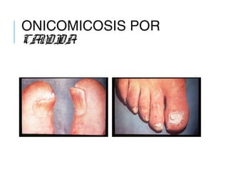 ONICOMICOSIS POR
CANDIDA
 