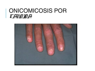 ONICOMICOSIS POR
CANDIDA
 