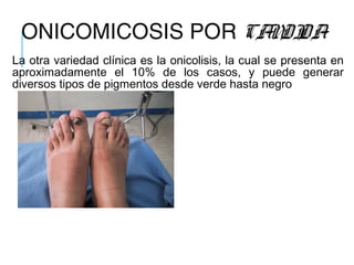 ONICOMICOSIS POR CANDIDA
La otra variedad clínica es la onicolisis, la cual se presenta en
aproximadamente el 10% de los casos, y puede generar
diversos tipos de pigmentos desde verde hasta negro
 